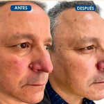 TagRecede™ - Elimina verrugas sin dolor y seguro + ENVIO GRATIS