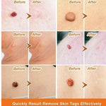 TagRecede™ - Elimina verrugas sin dolor y seguro + ENVIO GRATIS