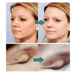 TagRecede™ - Elimina verrugas sin dolor y seguro + ENVIO GRATIS