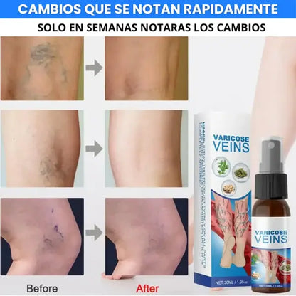 2x1 🩺 Varicose Veins™ Pro Tratamiento Intensivo Avanzado para Venas, Varices y Piernas Cansadas
