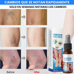 2x1 🩺 Varicose Veins™ Pro Tratamiento Intensivo Avanzado para Venas, Varices y Piernas Cansadas